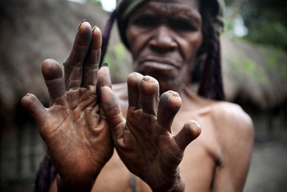 dani-tribe-no-fingers