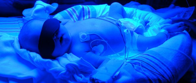 https://assets.roar.media/Hindi/2018/05/Newborn-Jaundice-Bilirubin-Phototherapy.jpg